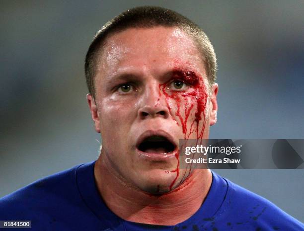 Corey Hughes of the Bulldogs walks off the field after getting hit above the eye during the round 17 NRL match between the Bulldogs and the South...