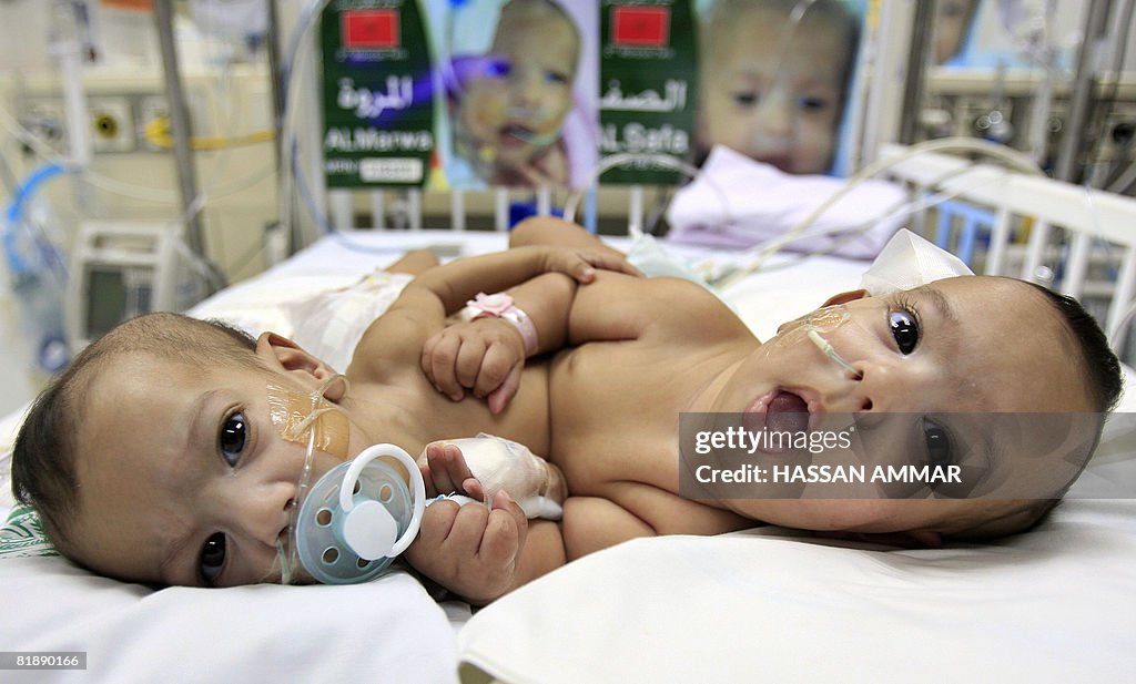 Moroccan conjoined twins al-Safa (R) and