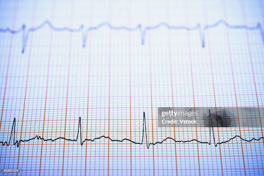 Close up of ekg printout