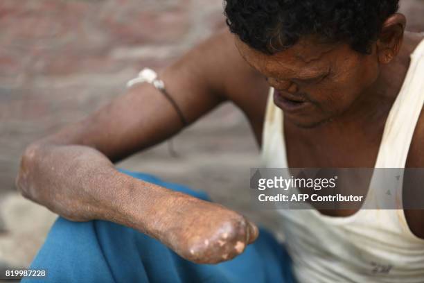 This photo taken on July 13, 2017 shows leprosy sufferer Ram, who lost his hands and toes to the disease, begging on the streets of Kathmandu....