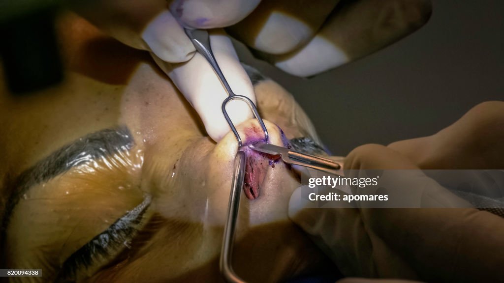 Scalpel incision for nasal septun deviation and rhinoplasty surgery on female patient