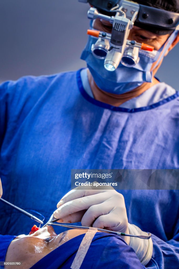 Surgeon doing surgical suture of nasal septun deviation and rhinoplasty surgery on female patient