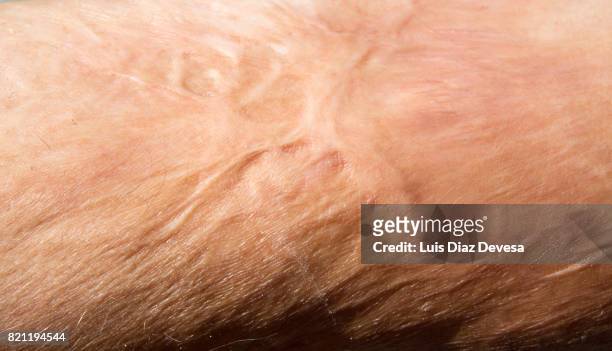 burn marks - damaged skin stock pictures, royalty-free photos & images