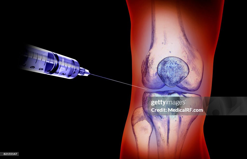 Knee Injection High-Res Vector Graphic - Getty Images