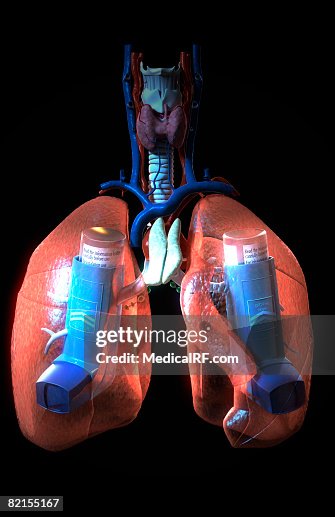 Asthma Asthma