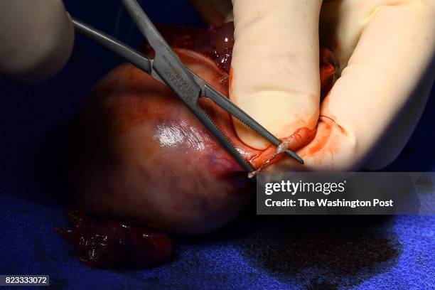 Dr. Paul J. MacKoul shows how the Essure device has adhered inside the fallopian tubes that he removed along with the uterus of Melissa Gilbert May...