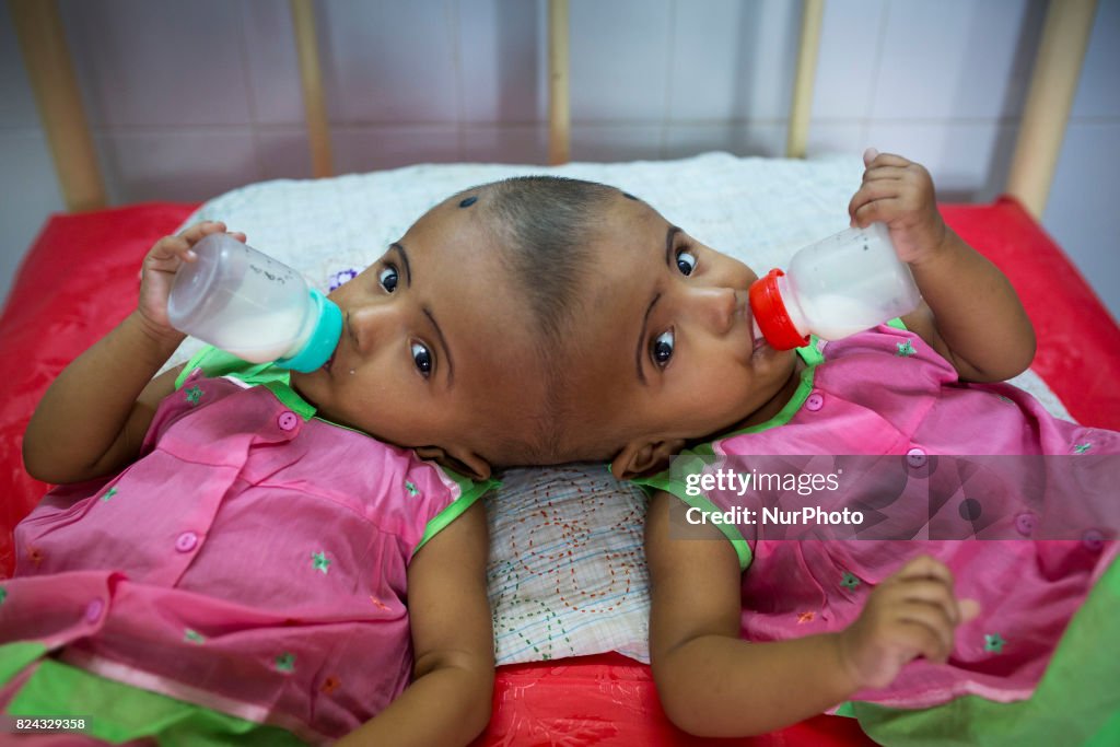 Bangladeshi twins born joined at skull