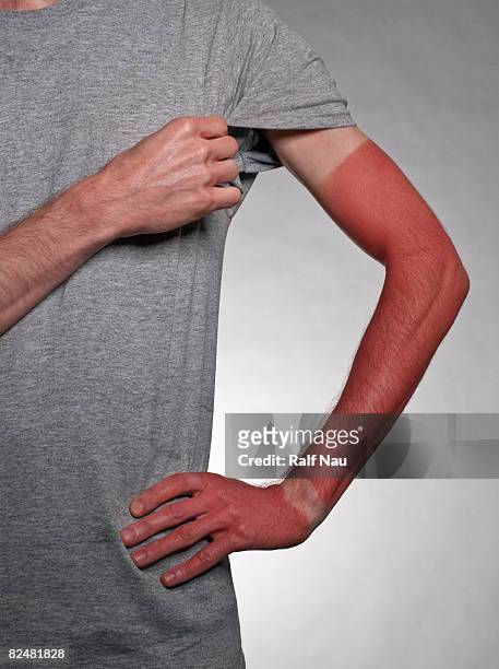 sunburn on arm - 日焼け ストックフォトと画像
