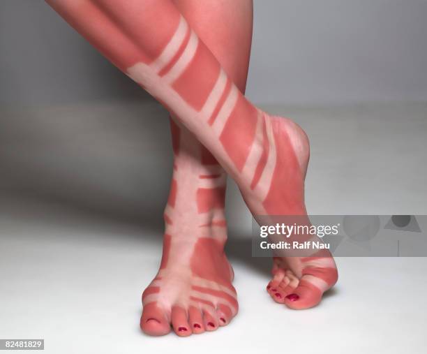 sunburn of person wearing gladiator sandals - coup de soleil photos et images de collection