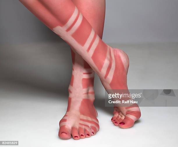 sunburn of person wearing gladiator sandals - sunburned 個照片及圖片檔