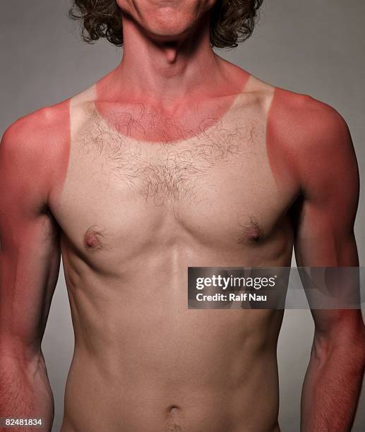 portrait of male with bad sunburn - marque de bronzage photos et images de collection