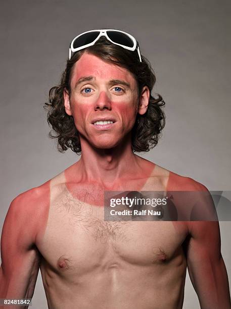 portrait of male with bad sunburn - sunburned stock pictures, royalty-free photos & images