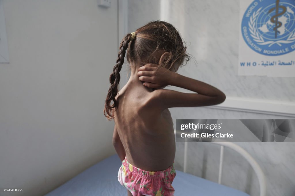 MALNOURISHED CHILD IN YEMEN