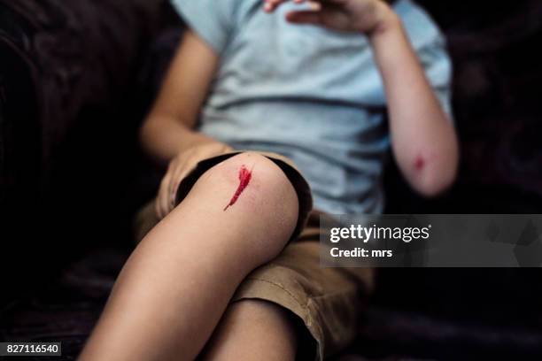 boy with scraped knee - wounded stockfoto's en -beelden