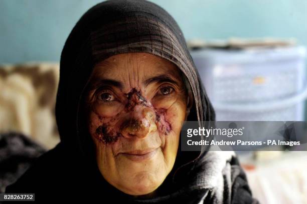 Woman suffering from leishmaniasis, a disease transmitted by sand flies, at the Maywand Hospital in Kabul, Afghanistan, Wednesday December 14 where...