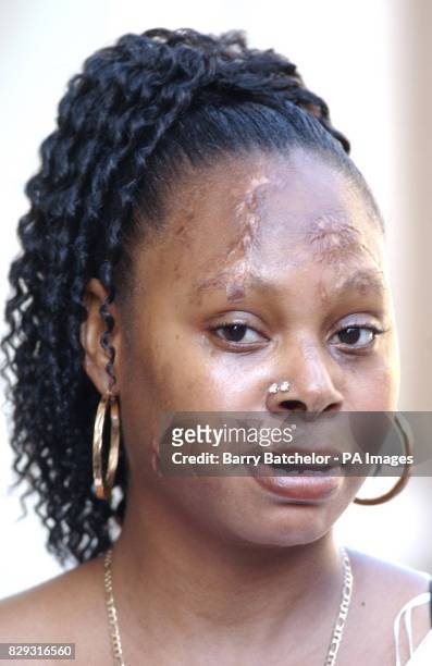 Pauline Williams a victim of an acid attack, standing outside Bristol Crown Court where Leane Jackson received a four year jail sentence. Jackson...