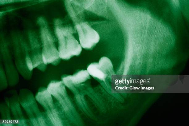 close-up of a dental x-ray - dental record stock pictures, royalty-free photos & images