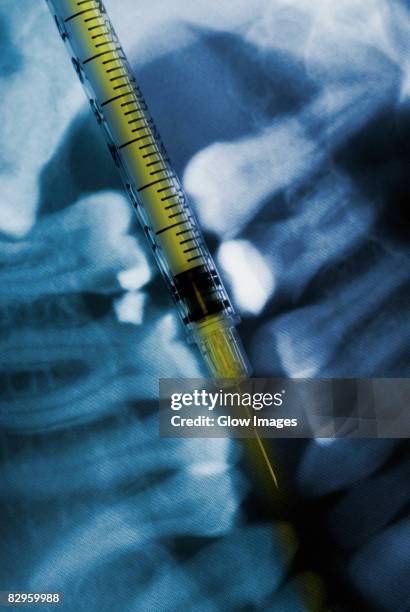 close-up of a syringe and a dental x-ray - ficha-dentária imagens e fotografias de stock