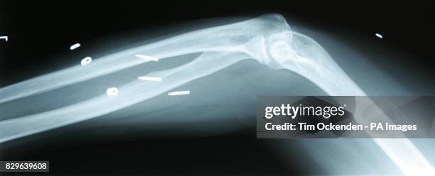 An X-ray of implanted BION . The device will allow the patient, Fran Read from Poole in Dorset, to return to playing netball. Mrs Read, who was left...