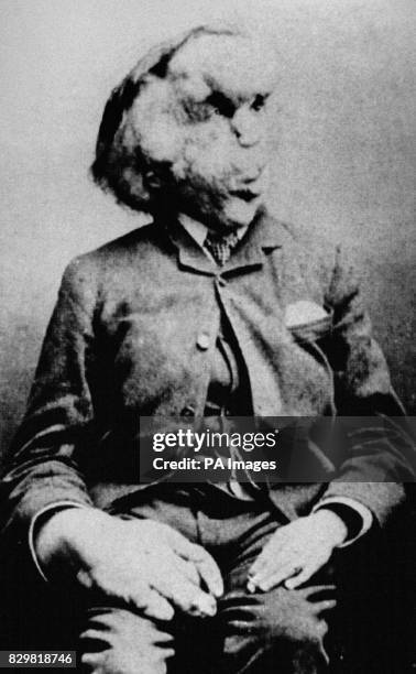 JOSEPH CARY MERRICK, VICTORIAN ENGLAND'S FAMOUS "ELEPHANT MAN" IS SHOWN IN A PHOTO FROM THE RADIOLOGICAL SOCIETY OF NORTH AMERICA. IN THE CENTURY...
