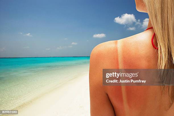 young woman on beach with sunburn, rear view - sunburned stock pictures, royalty-free photos & images