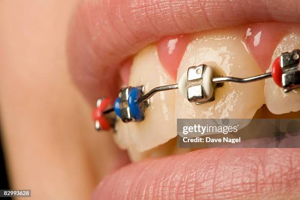 braces on a 12 years old  girl - orthodontics ストックフォトと画像