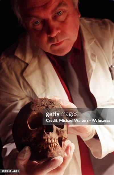 Human Osteologist Bill White cradles the skull of a woman syphilis sufferer dating from the 18th century today . The skull will join other remains...