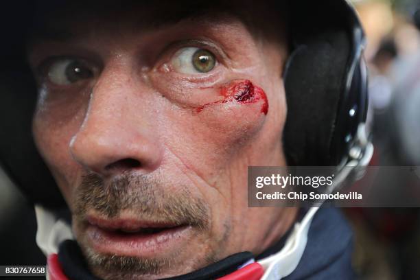 White supremacist is cut below his eye during clashes with counter-protesters at Emancipation Park after the "Unite the Right" rally was declared an...
