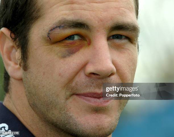 Great Britain Rugby League player Adrian Morely showing his eye injury after playing for Bradford Bulls during their victory in the Super League...