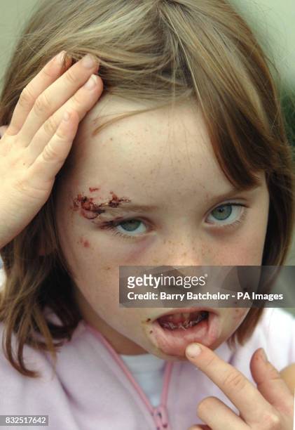 Hannah Russell, aged seven, from Cam, Gloucestershire, shows the injuries to her face and the inside of her mouth after an attack by a dog.