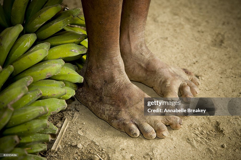 Deformed feet with bananas