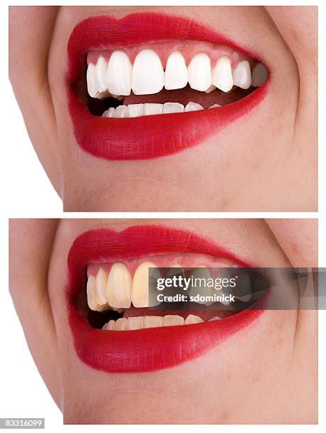 teeth whitening before and after - before and after teeth stock pictures, royalty-free photos & images