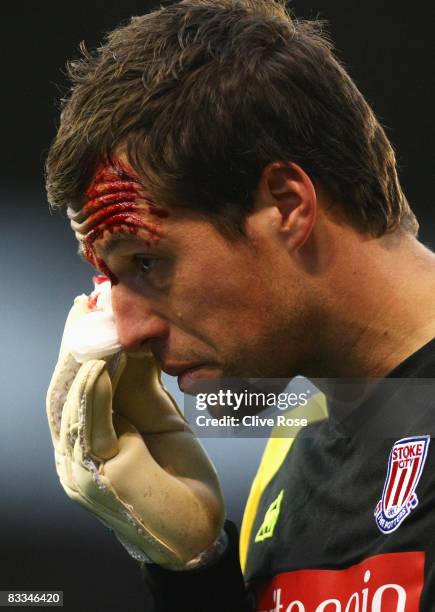 Thomas Sorensen of Stoke City leaves the field as blood pours from a cut during the Barclays Premier League match between Stoke City and Tottenham...