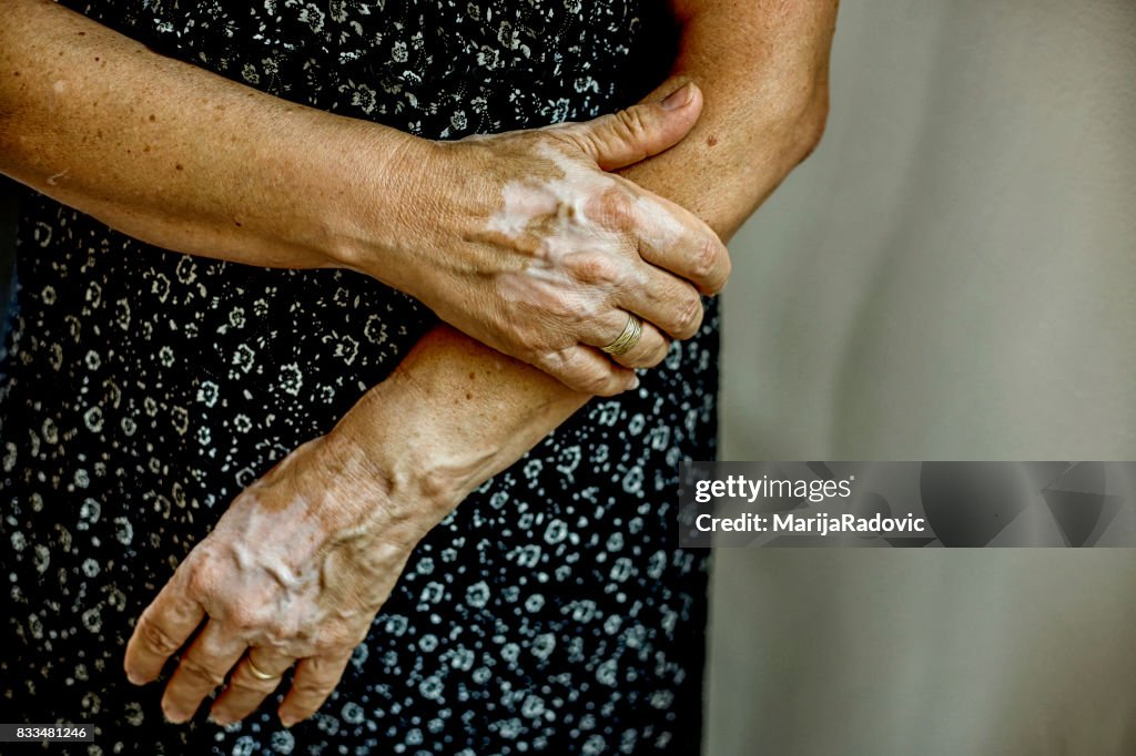 Retrato de mulher de vitiligo