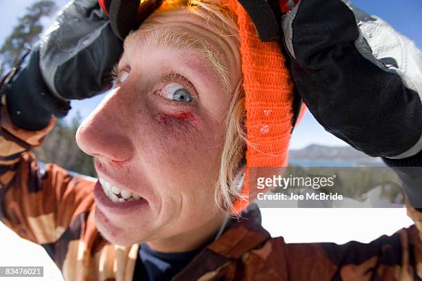 fisheye view of injured winter sports enthusiast. - cardenal lesión física fotografías e imágenes de stock