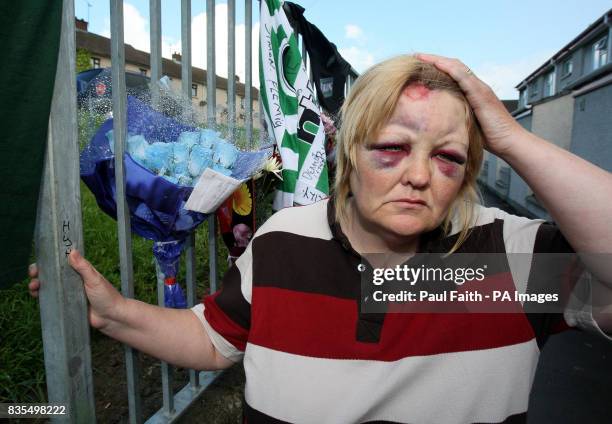 Evelyn McDaid, wife of Kevin McDaid, who was beaten to death by a sectarian mob, shows the wounds she received when trying to protect her husband....