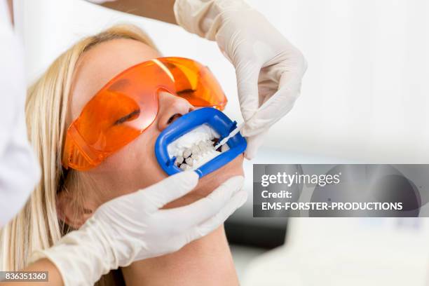 aesthetic cosmetic dentistry dental care - women with long blonde hair lying on chair with mouth open for tooth whitening bleaching wearing protective glasses and female doctor exam gloves applying gel to teeth while lip retractor mouth opener is inserted - retractor stock pictures, royalty-free photos & images