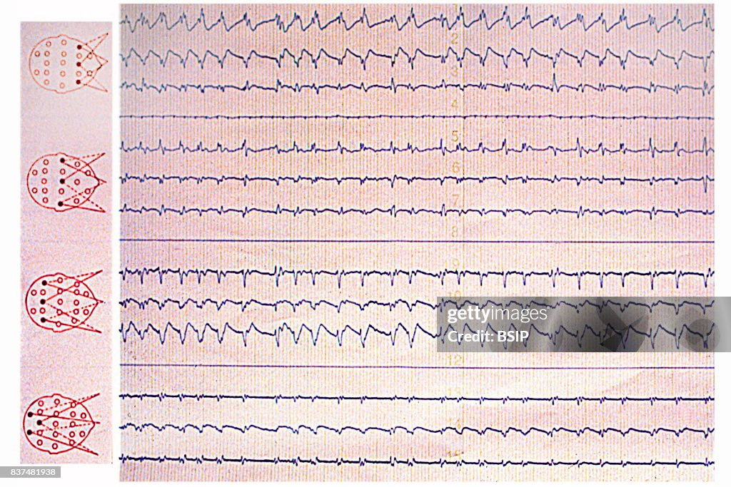 Sleep apnea syndrome