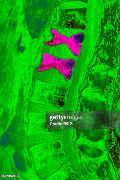 Osteoporosis with compression of L1-L2 vertebrae, seen on a sagittal plane MRI scan.