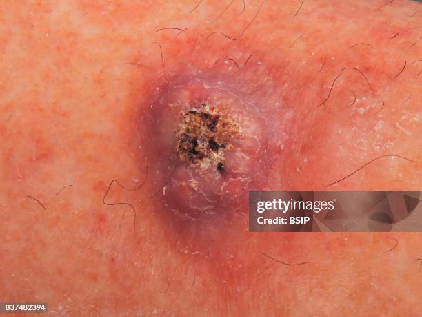 Invasive squamous cell carcinoma on the leg.