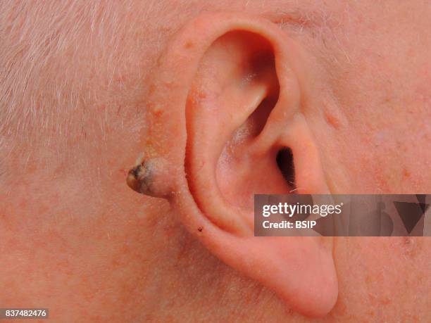 Squamous cell carcinoma on the ear.