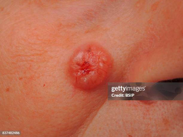 Basal cell carcinoma on the nasogenien groove.