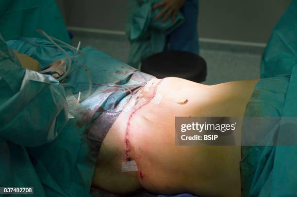 Saint Franois plastic surgery clinic, Nice, France, Abdominoplasty on man with loose skin after weight loss. Operation removing the excess skin and...