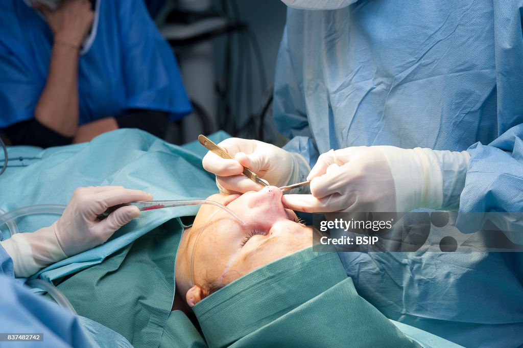 Nose plastic surgery
