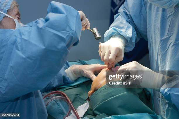 Mozart plastic surgery clinic, Nice, France. Rhinoplasty, median osteotomy, the surgeon breaks the bone bump and removes the small bone cap with an...