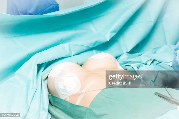 Mozart plastic surgery clinic, Nice, France. Fitting breast implants using the round block technique. The operation is finished: redons drain is in...