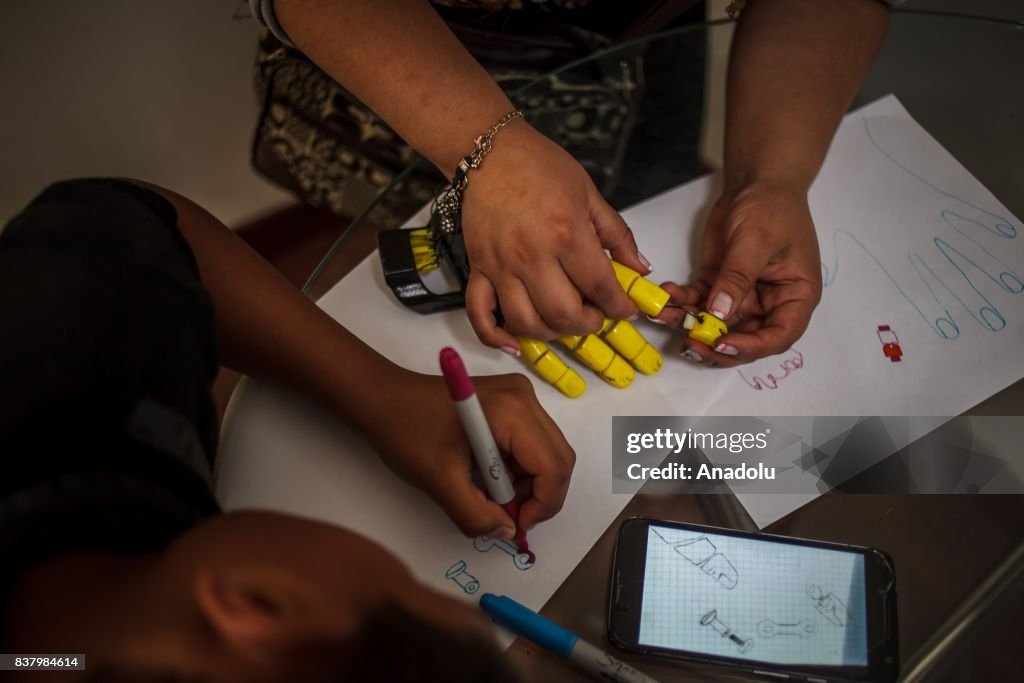 3D Prosthesis project for disabled people in Colombia