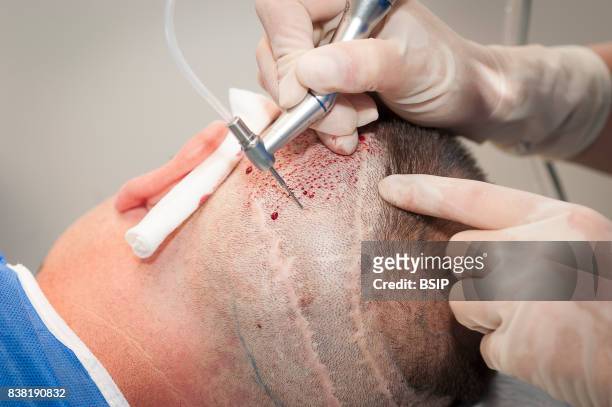Nice, France, FUE, Follicular Unit Extraction, hair transplant on a patient with earlier two strip harvesting sessions scars. FUE involves harvesting...