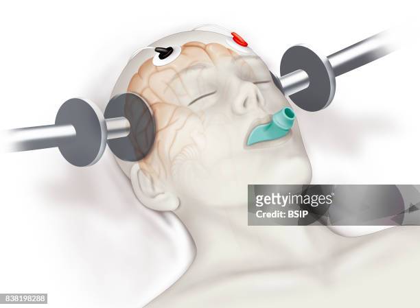 Illustration of a patient undergoing electroshock treatment for serious depression, or anti-depressant resistant depression. An electric current is...