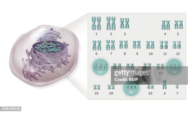 Illustration of the various trisomy's highlighted on a genetic map. Each person has 22 pairs of chromosomes and two unique sex chromosomes. Seen...
